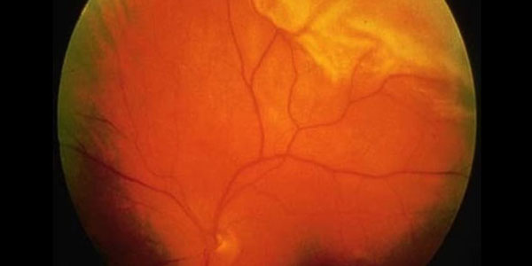 Cirugía para el Desprendimiento de Retina